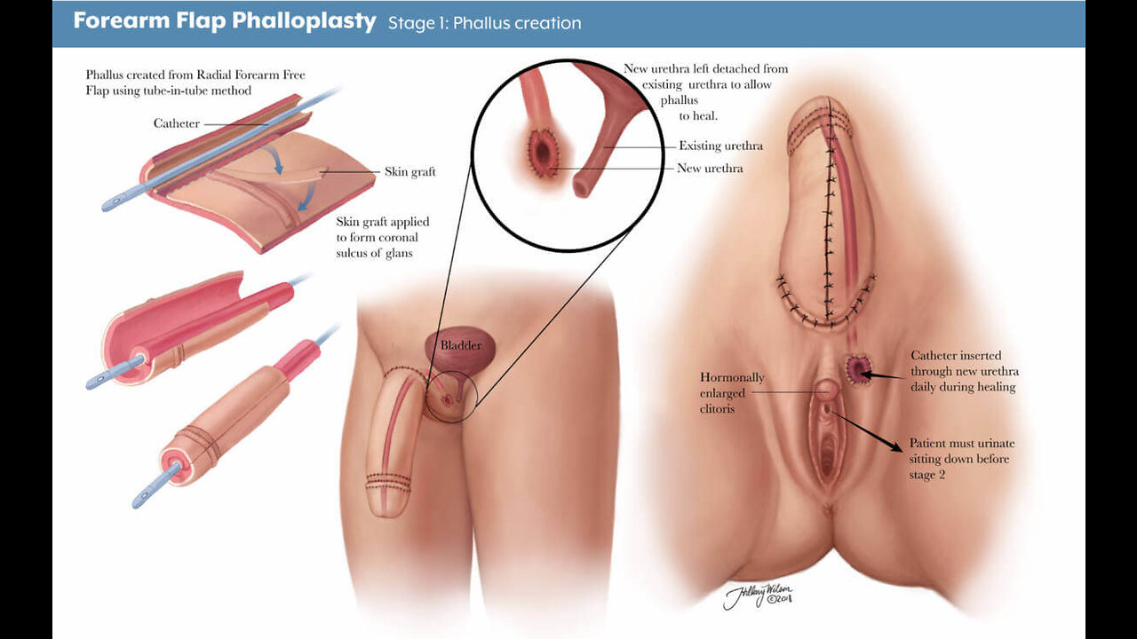 Ftm Mtf Porn