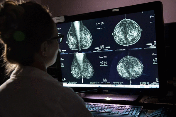 Expert panel that sparked mammogram controversy now says tests should start at 40