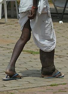 Lymphatic filariasis, also known as elephantitis, causes significant disfigurement and disability.
              Noah Seelam/AFP via Getty Images