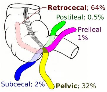 The appendix can be oriented in the body in multiple ways.
Mikael Häggström, M.D./Wikimedia Commons