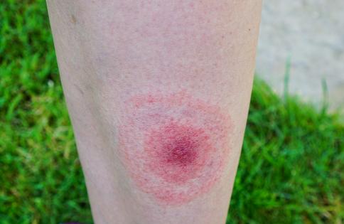 A common early sign of Lyme disease is a ‘bull’s-eye’ rash occurring in 70% to 80% of infected people.
              anakopa/iStock via Getty Images Plus