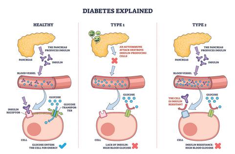 In people living with diabetes, cells don’t absorb glucose properly from the bloodstream.
              VectorMine/iStock via Getty Images Plus