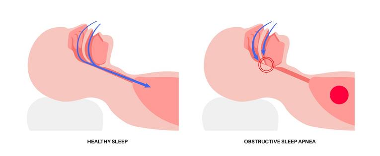 Sleep apnea is characterized by breathing blockages during sleep.
              Pikovit44/iStock via Getty Images Plus