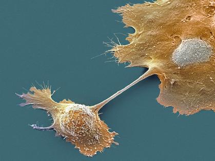 Pancreatic cancer has been notoriously difficult to treat. Steve Gschmeissner/Science Photo Library via Getty Images