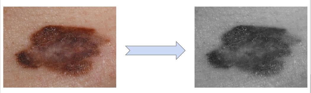 The researchers trained an AI model on images of moles on light skin, left. When the skin color was altered to simulate darker skin, right, the AI model’s accuracy at identifying melanoma fell sharply – illustrating how AI models can rely on skin color as a shortcut rather than learning the true diagnostic features of melanoma.
Mohamed Akrout, CC BY-SA