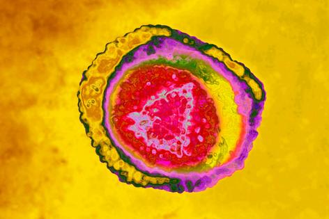 Varicella zoster virus, also known as human herpesvirus 3, causes chickenpox and shingles. BSIP/Universal Images Group via Getty Images