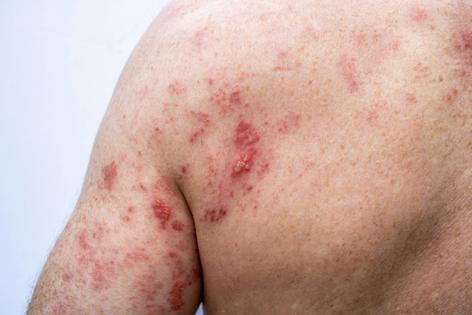 Shingles rashes can be debilitatingly painful.
              lauraag/iStock via Getty Images Plus