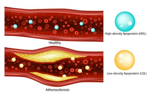 LDL or ‘good’ cholesterol contributes to healthy blood vessels, while HDL or ‘bad’ cholesterol can lead to blockages and narrowing of blood vessels.
              Sakkura/iStock via Getty Images Plus