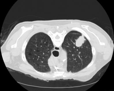 A low-dose CT scan can help with early detection of lung cancer. In this image, the tumor is the white nodule in the upper right corner of the black space.
              Atlas of Pulmonary Pathology/Flickr, CC BY-SA