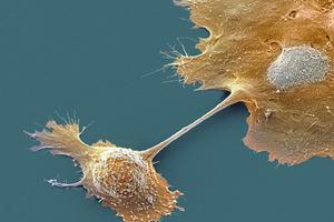 Pancreatic cancer has been notoriously difficult to treat. Steve Gschmeissner/Science Photo Library via Getty Images